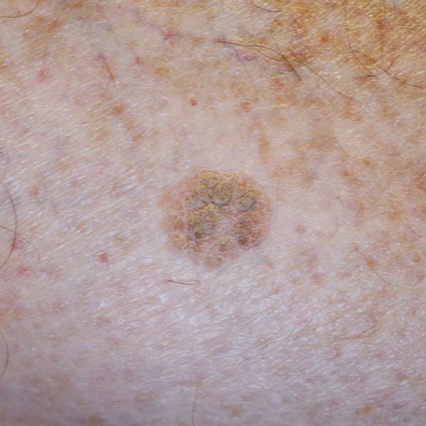 example of Actinic keratosis (AK)