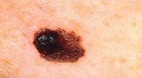 Asymmetry melanoma skin cancer
