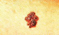Irregular Borders Melanoma Skin Cancer
