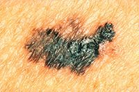 Uneven Colored Mole Melanoma Skin Cancer